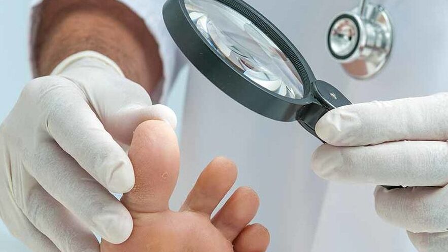 Kāju nagu sēnītes diagnostiku veic dermatologs
